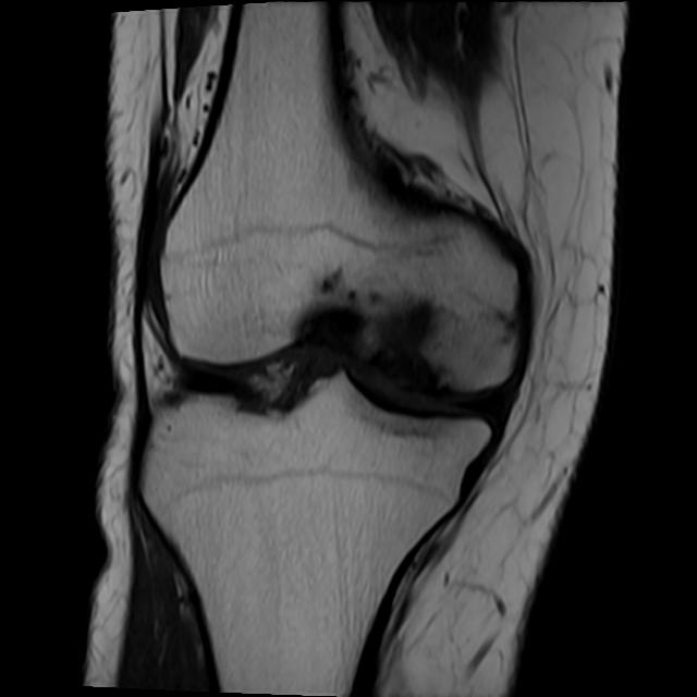 Osteochondritis dissecans | Image | Radiopaedia.org