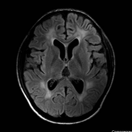 Acute Lymphocytic Leukemia With Cavernous Sinus And Subependymal Spread 