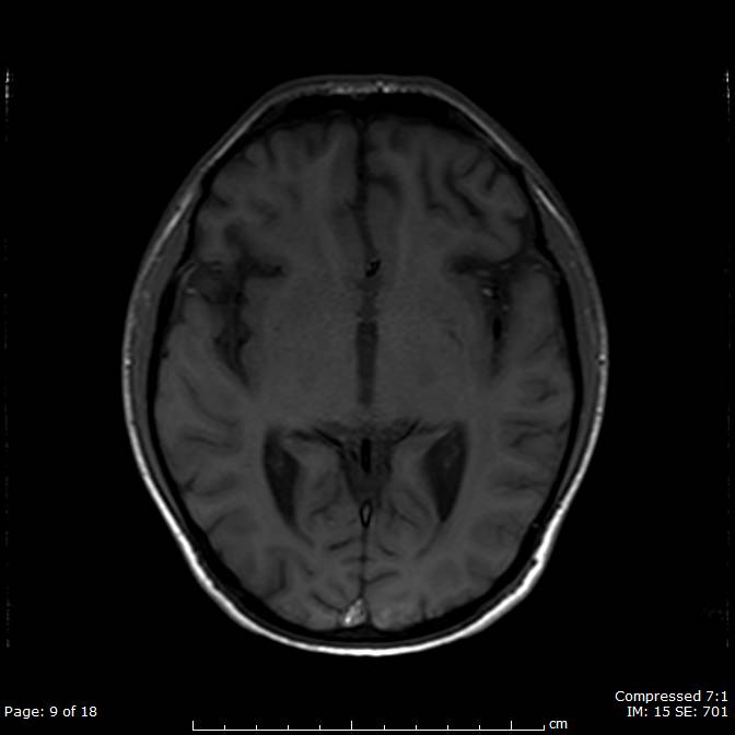 Perineural and subependymal spread of ALL | Image | Radiopaedia.org