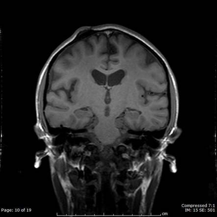 Perineural and subependymal spread of ALL | Image | Radiopaedia.org