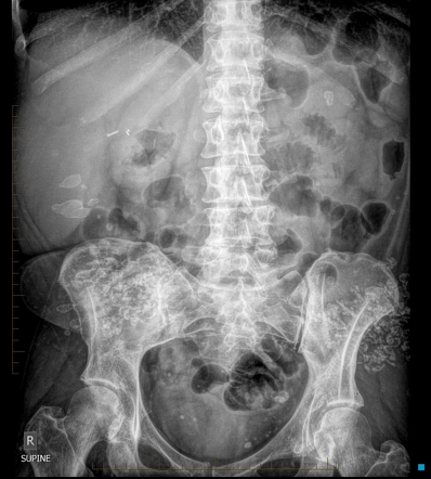 Multiple buttock injection granulomas - progressive CT features ...