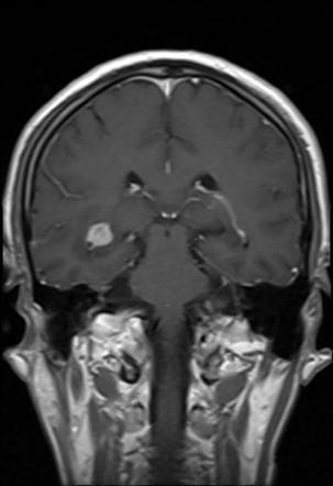 Tuberculoma - intraventricular | Radiology Case | Radiopaedia.org