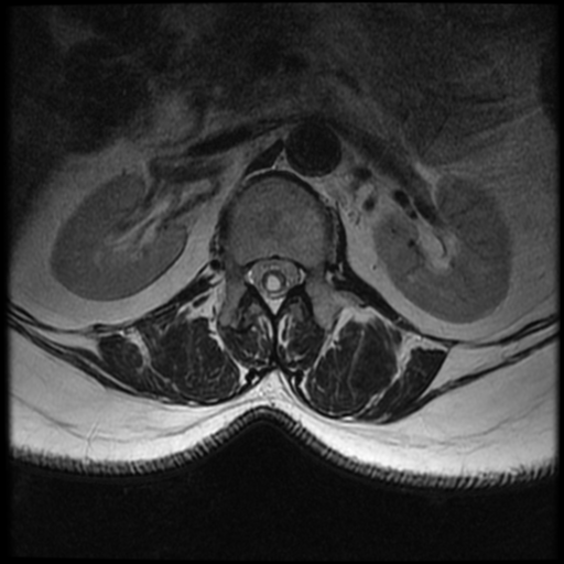 Intramedullary spinal metastasis | Image | Radiopaedia.org