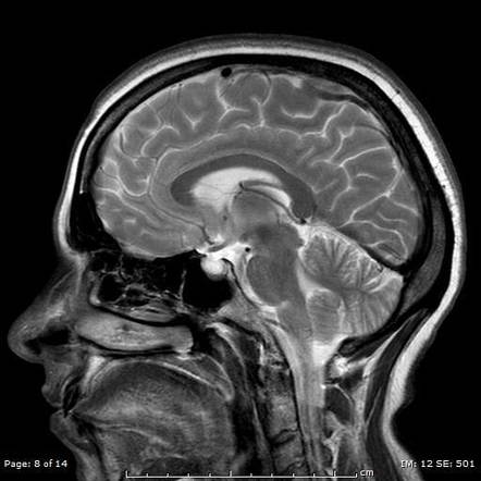 Pseudotumor cerebri | Image | Radiopaedia.org