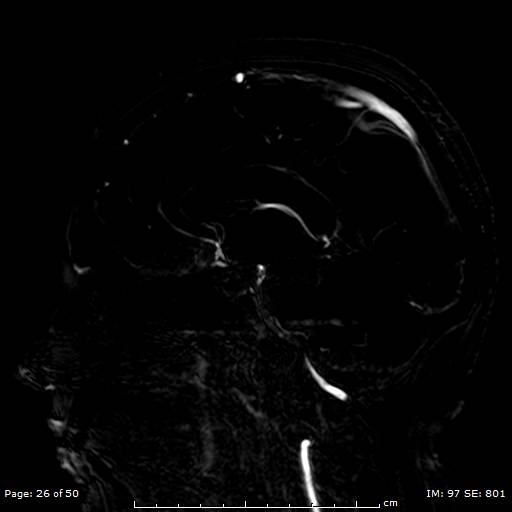 Pseudotumor Cerebri | Image | Radiopaedia.org