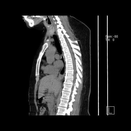 Lymphocytic interstitial pneumonitis | Image | Radiopaedia.org