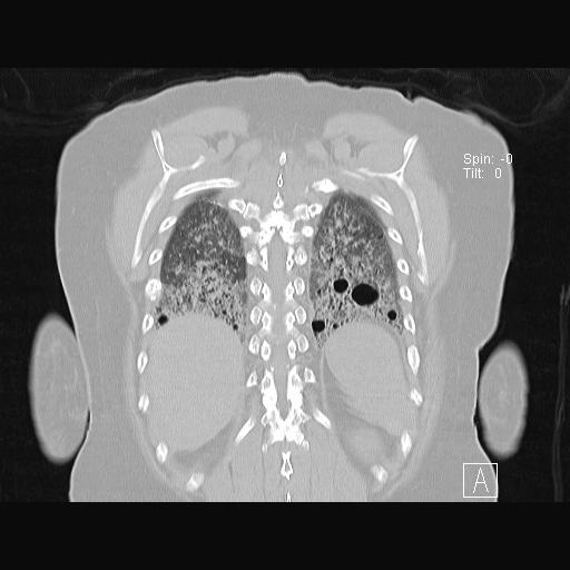 Lymphocytic interstitial pneumonitis | Image | Radiopaedia.org