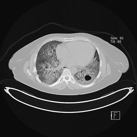 Lymphocytic interstitial pneumonitis | Image | Radiopaedia.org