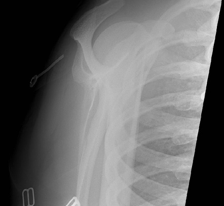 Acromioclavicular joint injury - grade 4 | Image | Radiopaedia.org