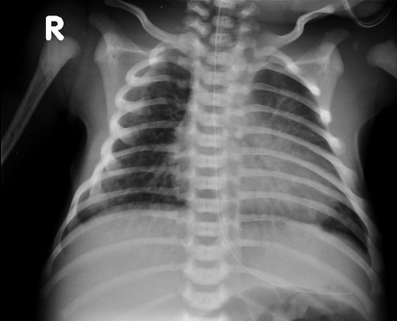 Meconium aspiration syndrome | Radiology Case | Radiopaedia.org