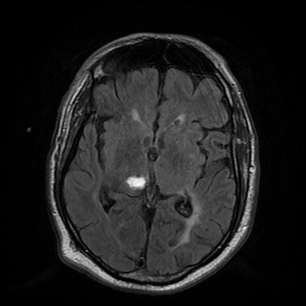 Cerebral embolic infarcts (embolic shower) | Image | Radiopaedia.org