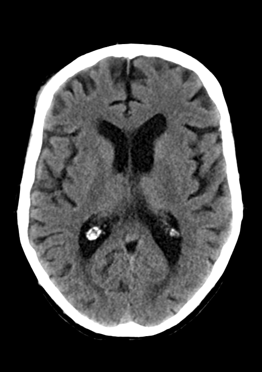 Traumatic Direct Caroticocavernous Fistula 