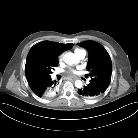 Three Column T3 Fracture With Mediastinal Hematoma 