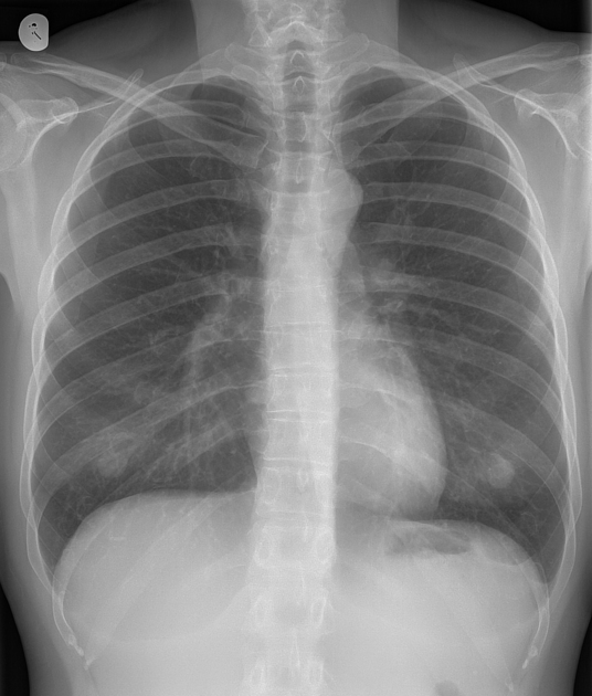 Nipple shadows | Radiology Reference Article | Radiopaedia.org