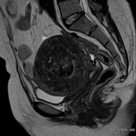 Submucosal uterine leiomyoma | Radiology Reference Article ...