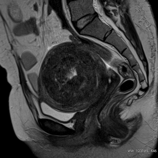 Submucosal fibroid on MRI | Image | Radiopaedia.org