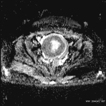 Submucosal Fibroid On Mri Image Radiopaedia Org