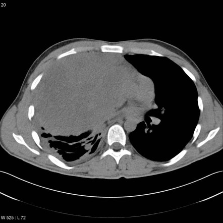 Mediastinal teratoma | Radiology Reference Article | Radiopaedia.org