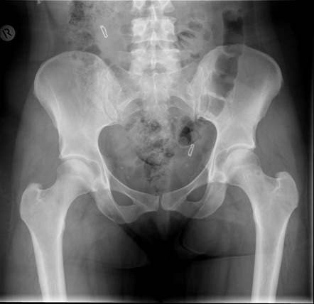 Pitt pit | Radiology Case | Radiopaedia.org