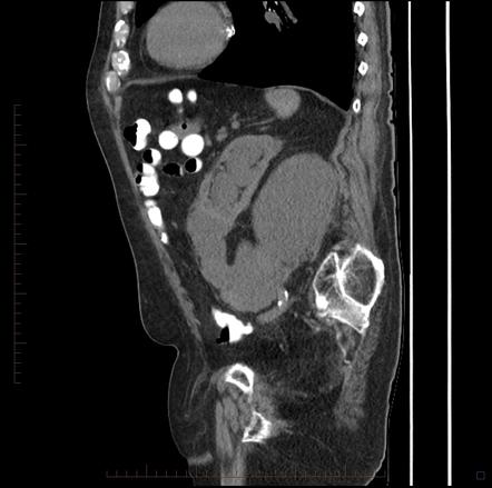 case seconday urinoma obstruction ureteric calyceal rupture chronic radiopaedia