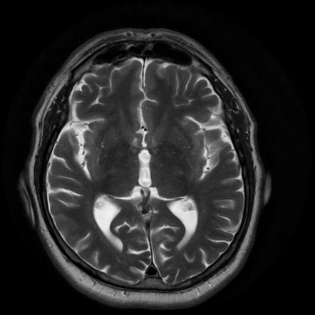 Astrocytoma (mesial temporal) | Image | Radiopaedia.org