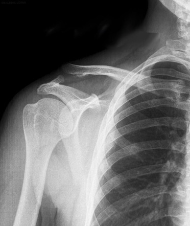 Rockwood classification of acromioclavicular joint injury | Radiology ...