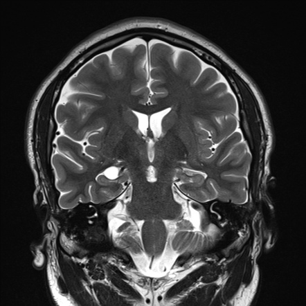 Choroid fissure cyst | Image | Radiopaedia.org