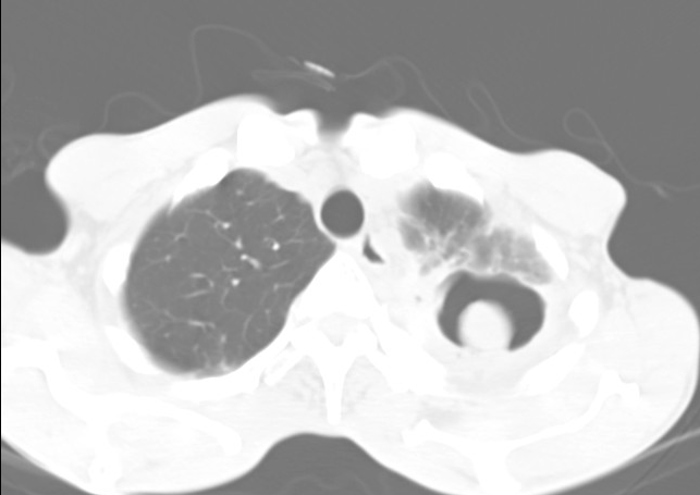 Aspergilloma | Image | Radiopaedia.org