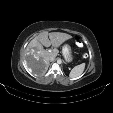 Giant hepatic hemangioma | Radiology Reference Article | Radiopaedia.org