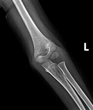 Supracondylar fracture | Radiology Case | Radiopaedia.org