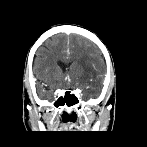 Anaplastic astrocytoma IDH wild-type | Image | Radiopaedia.org