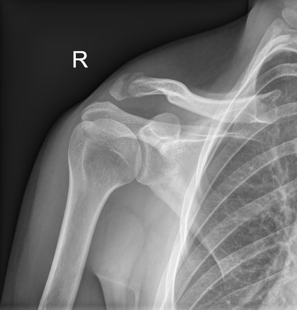 Distal clavicle fracture | Radiology Case | Radiopaedia.org