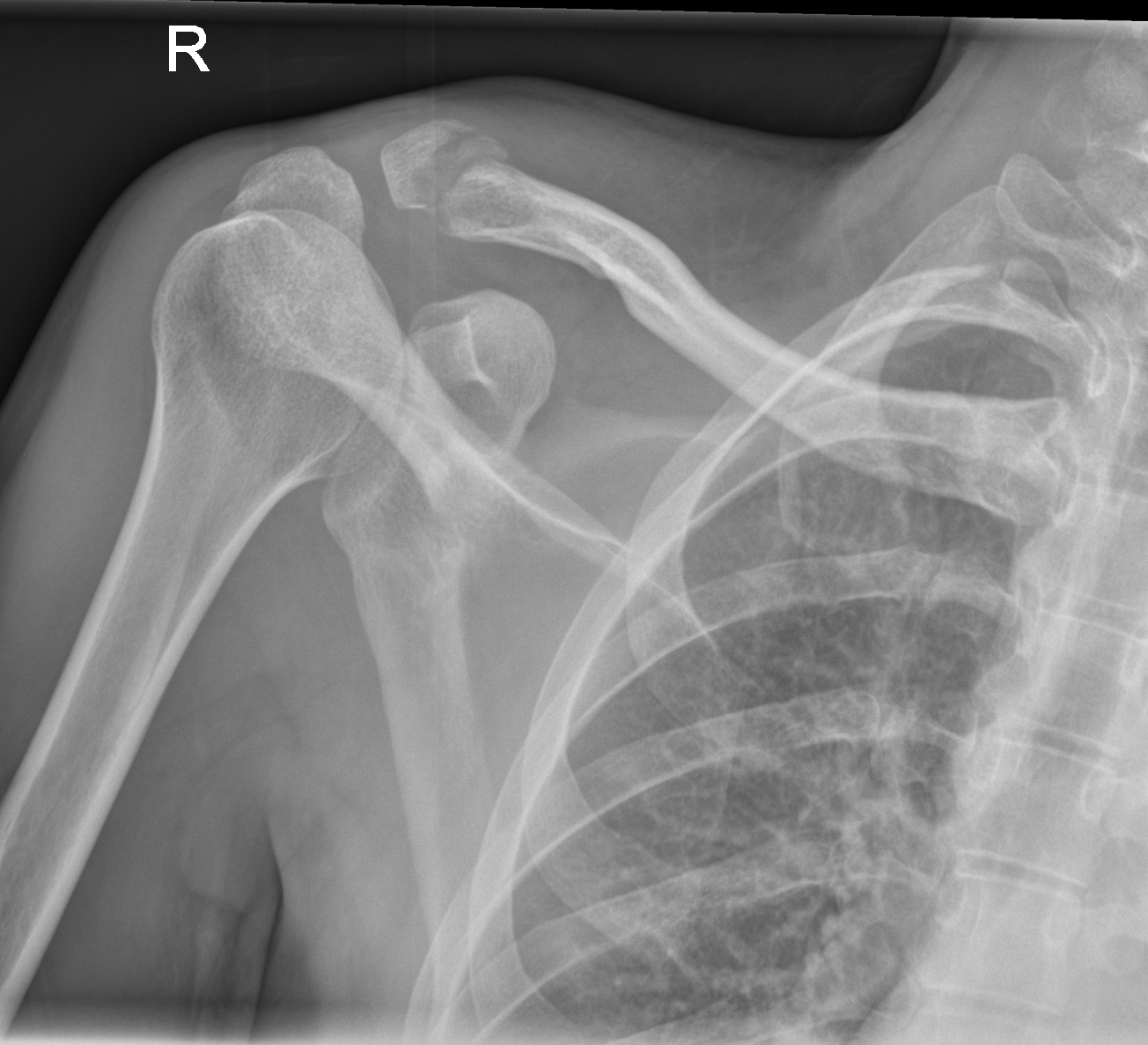 Distal Clavicle Fracture 