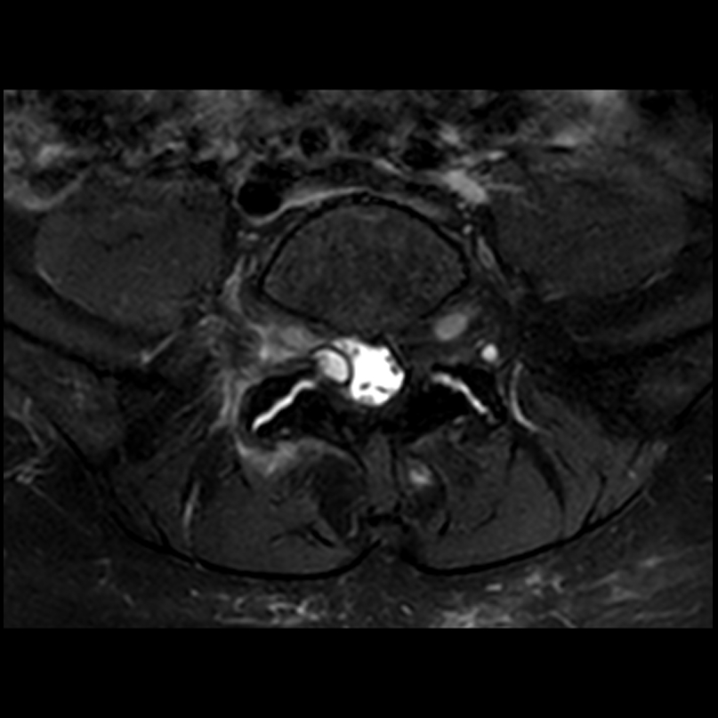 Facet Joint Ganglion Cyst Mri at Phillip John blog