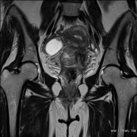 Paracervical leiomyoma | Image | Radiopaedia.org