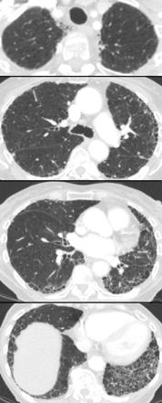 Reticular Interstitial Pattern | Radiology Reference Article ...