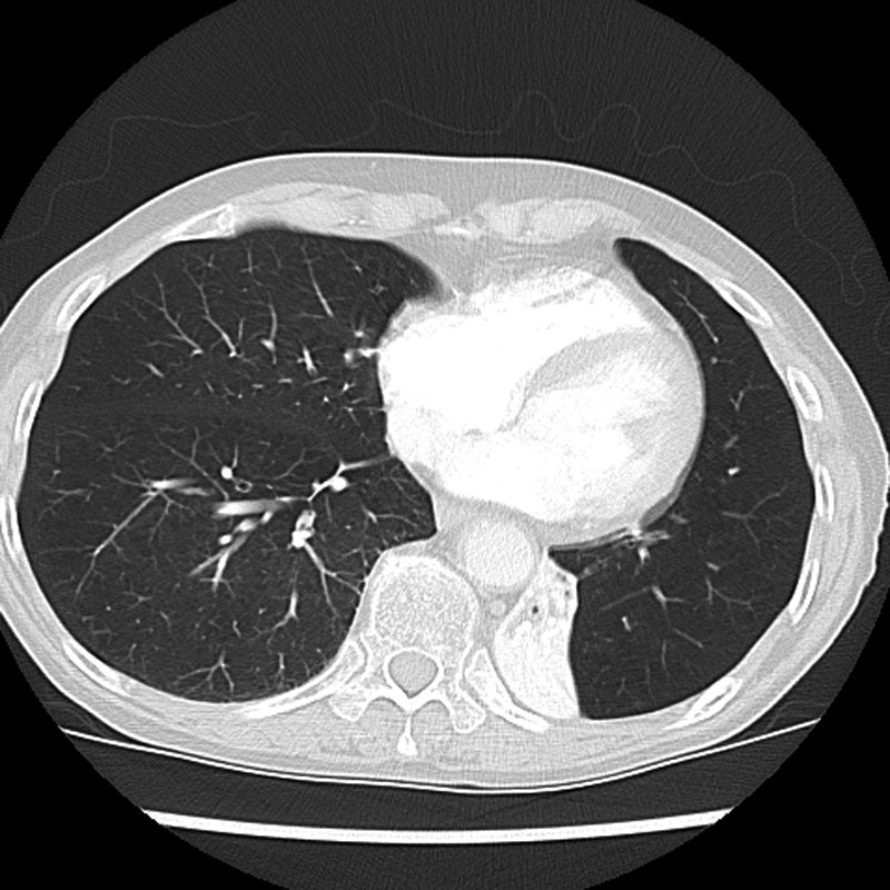 Left lower lobe collapse | Image | Radiopaedia.org