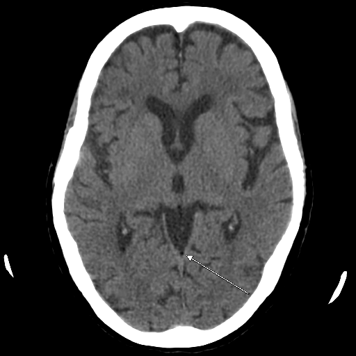 Fatty falx on CT | Image | Radiopaedia.org