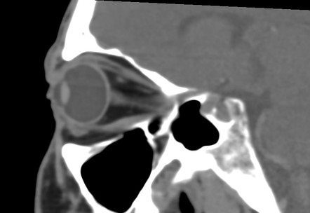 Traumatic Globe Rupture Image Radiopaedia Org