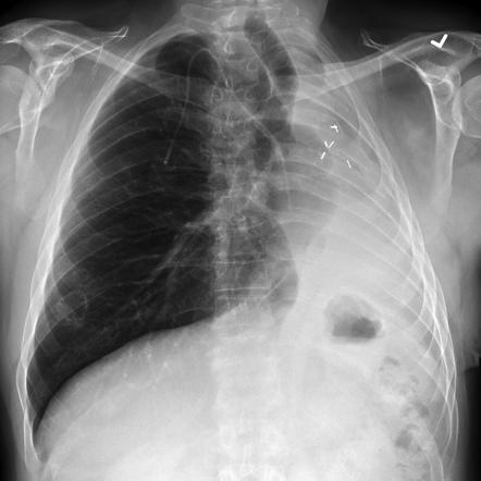 Previous pneumonectomy | Radiology Case | Radiopaedia.org