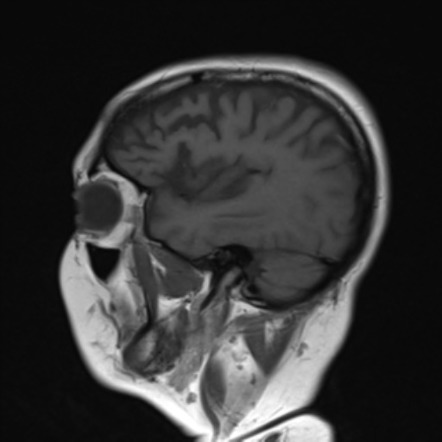 Behavioural Variant Frontotemporal Lobar Degeneration | Radiology ...