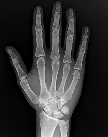 Boxer Fracture Radiology Reference Article Radiopaedia Org