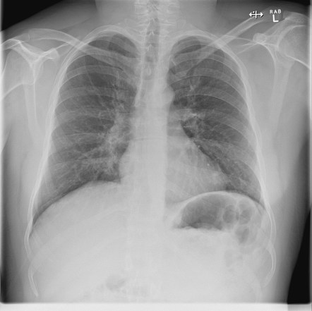 Alpha-1-antitrypsin deficiency | Radiology Case | Radiopaedia.org