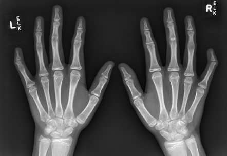 Multiple synostoses syndrome | Radiology Reference Article ...