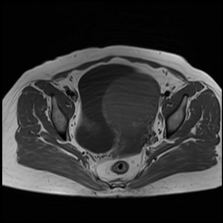 Intramural fibroid (MRI) | Radiology Case | Radiopaedia.org