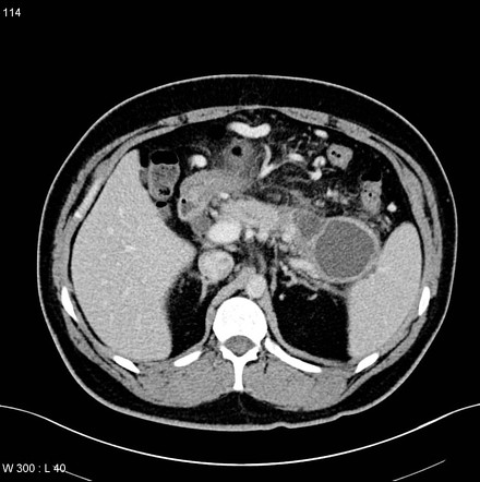 Chronic Pancreatitis And Pseudocysts 