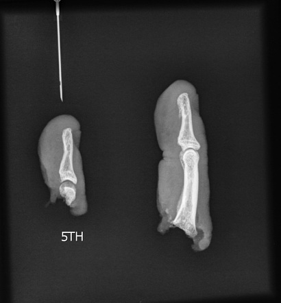 Traumatic Finger Amputation | Radiology Case | Radiopaedia.org