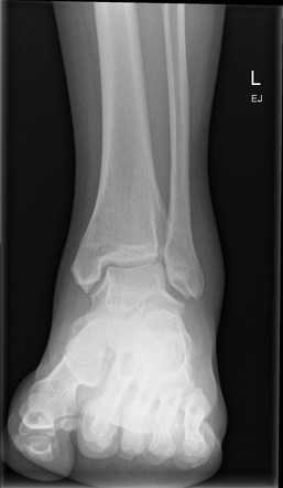 Anterior calcaneal process fracture | Radiology Case | Radiopaedia.org