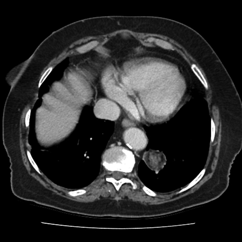 Pulmonary hamartoma | Image | Radiopaedia.org