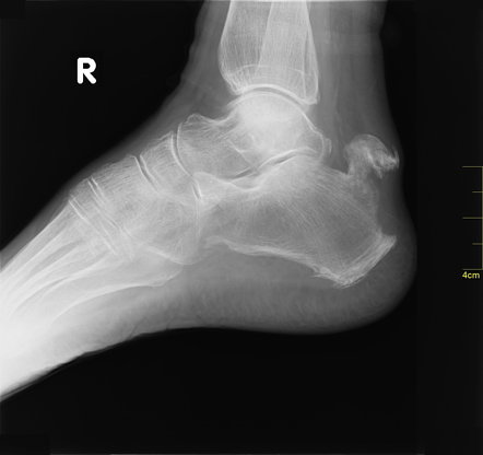 Calcaneal tuberosity avulsion fracture | Radiology Case | Radiopaedia.org